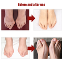 Bye Joanete™ – Alívio imediato e proteção diária 👣